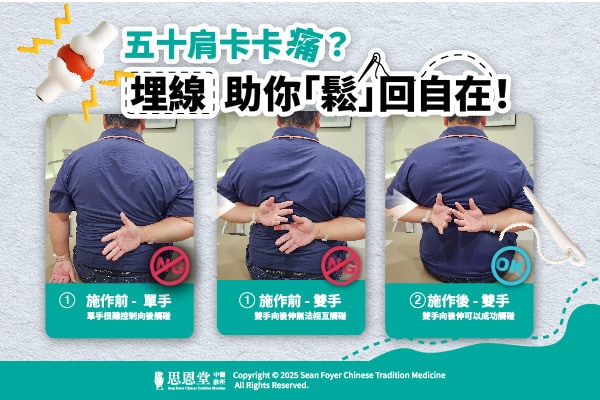 五十肩埋線治療前後向後伸展動作紀錄